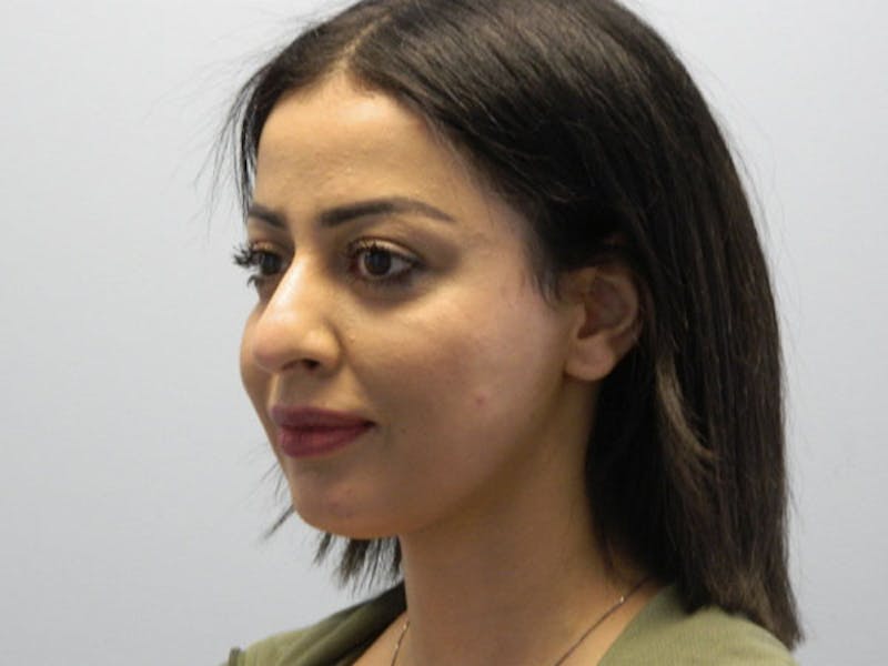 Rhinoplasty Before & After Gallery - Patient 133066588 - Image 5