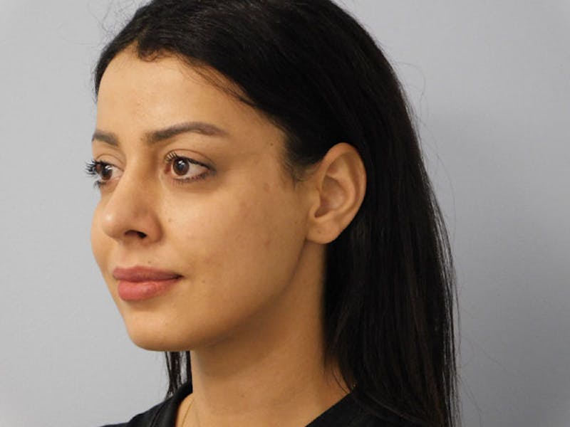 Rhinoplasty Before & After Gallery - Patient 133066588 - Image 6