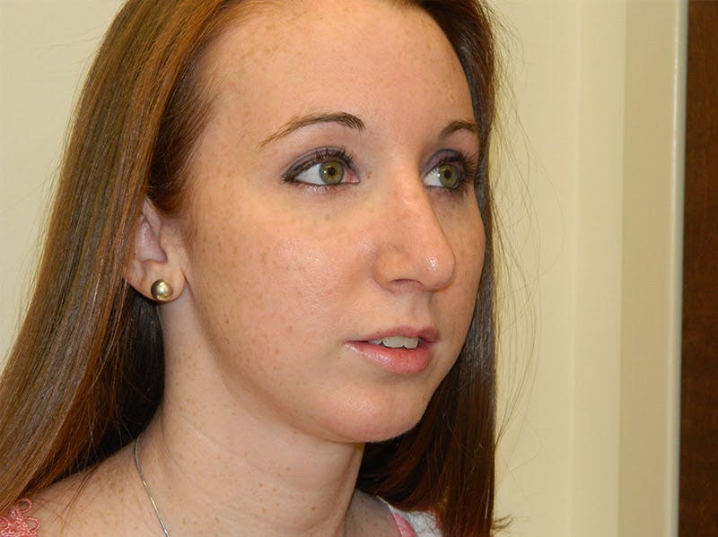 Chin Augmentation Before & After Gallery - Patient 133066587 - Image 6