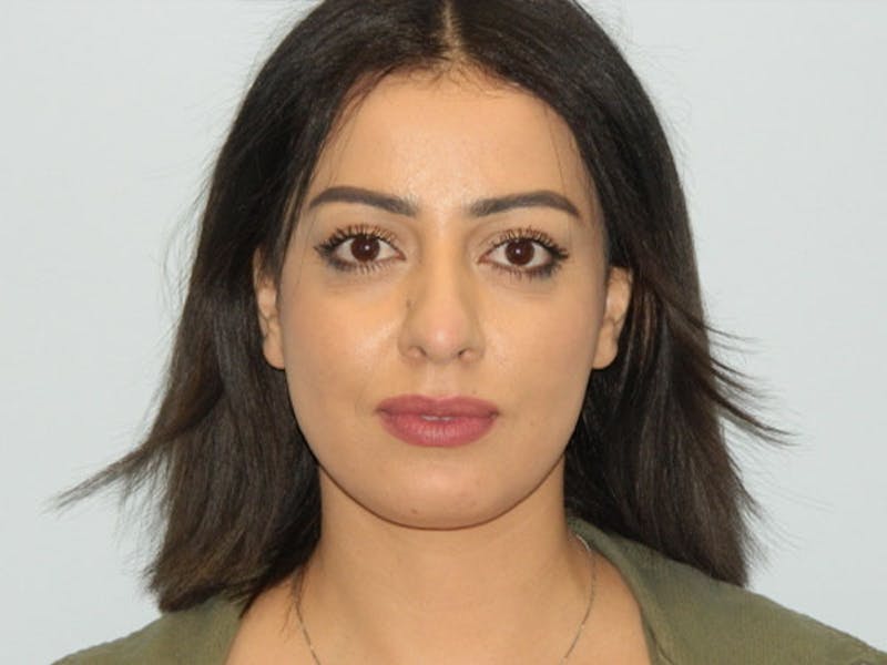 Rhinoplasty Before & After Gallery - Patient 133066588 - Image 7