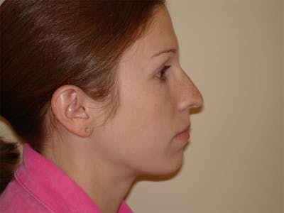 Chin Augmentation Before & After Gallery - Patient 133066589 - Image 1