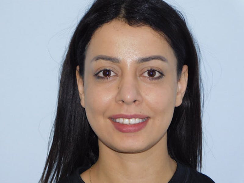 Rhinoplasty Before & After Gallery - Patient 133066588 - Image 8