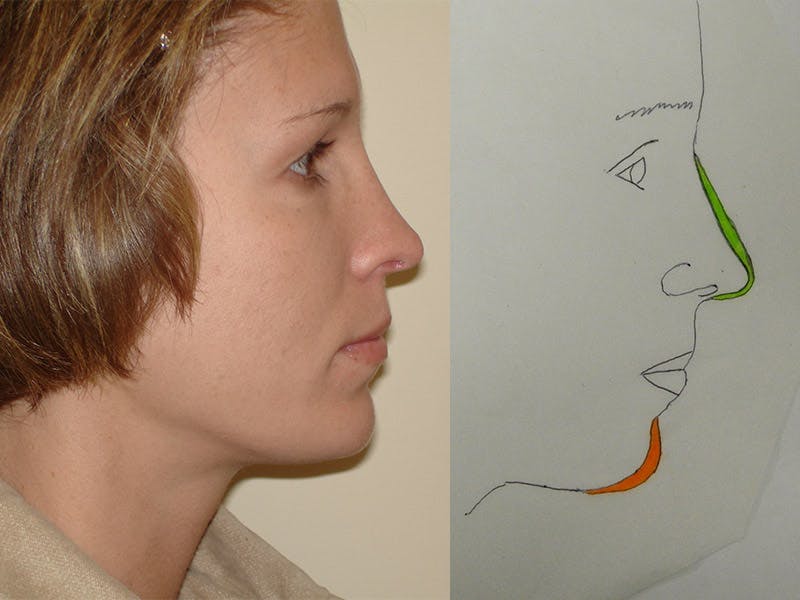 Chin Augmentation Before & After Gallery - Patient 133066589 - Image 2