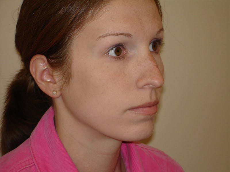 Chin Augmentation Before & After Gallery - Patient 133066589 - Image 3