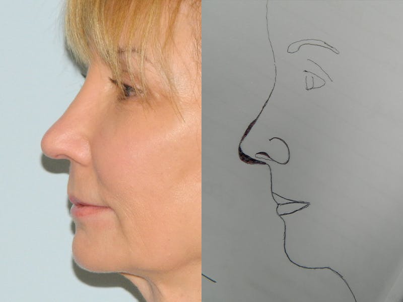 Rhinoplasty Before & After Gallery - Patient 133066591 - Image 2
