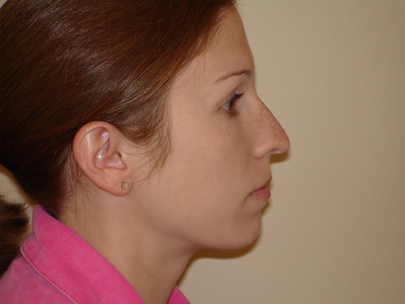 Chin Augmentation Before & After Gallery - Patient 133066589 - Image 5