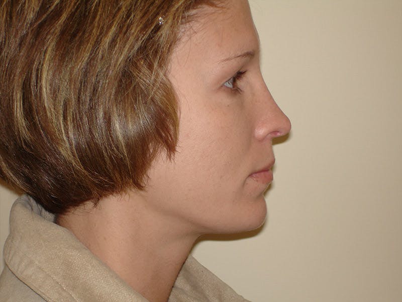 Chin Augmentation Before & After Gallery - Patient 133066589 - Image 6