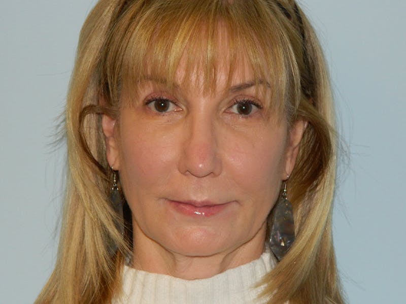 Rhinoplasty Before & After Gallery - Patient 133066591 - Image 4