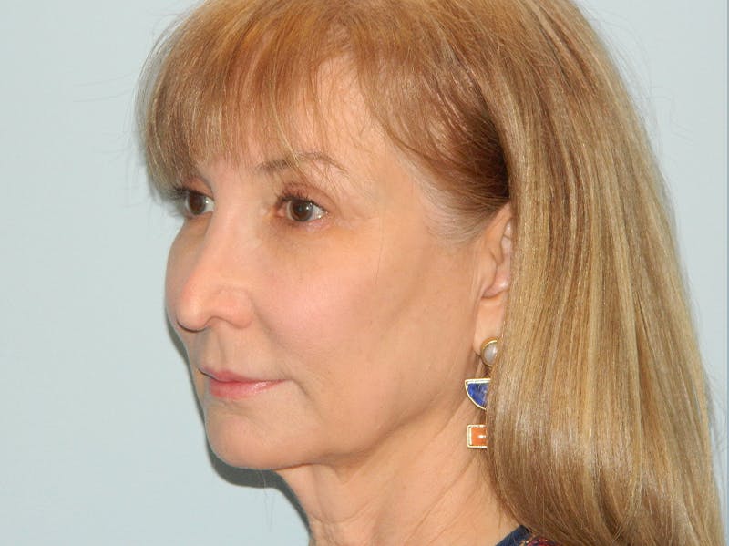 Rhinoplasty Before & After Gallery - Patient 133066591 - Image 5