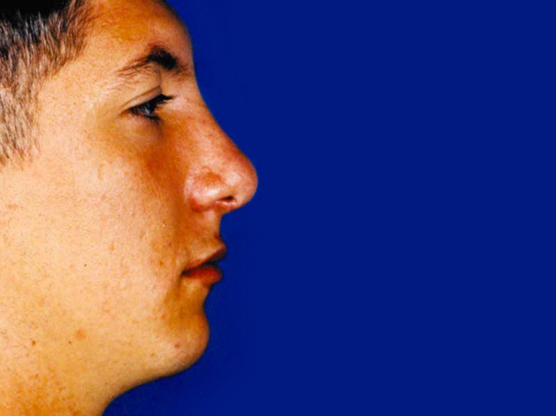 Chin Augmentation Before & After Gallery - Patient 133066590 - Image 2