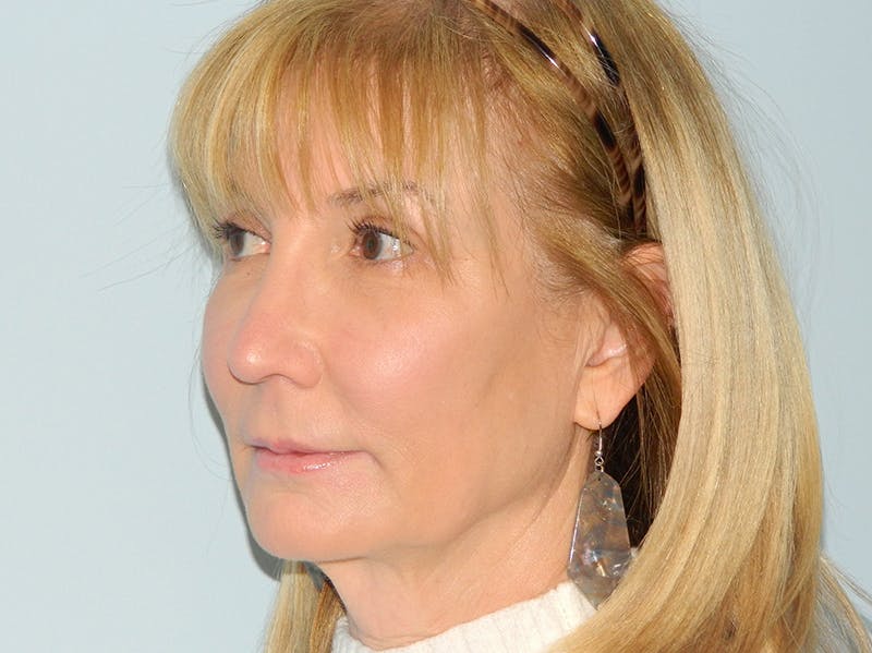 Rhinoplasty Before & After Gallery - Patient 133066591 - Image 6