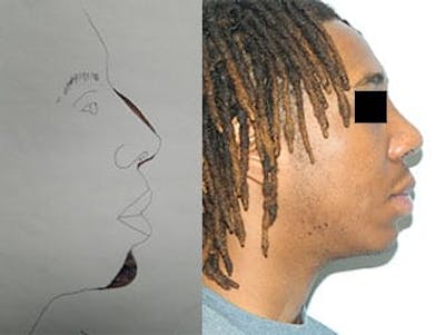 Chin Augmentation Before & After Gallery - Patient 133066592 - Image 2