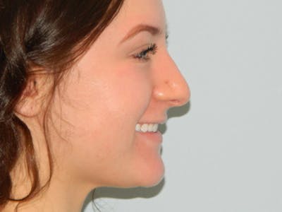 Rhinoplasty Before & After Gallery - Patient 133066594 - Image 1