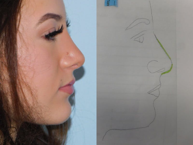 Rhinoplasty Before & After Gallery - Patient 133066594 - Image 2