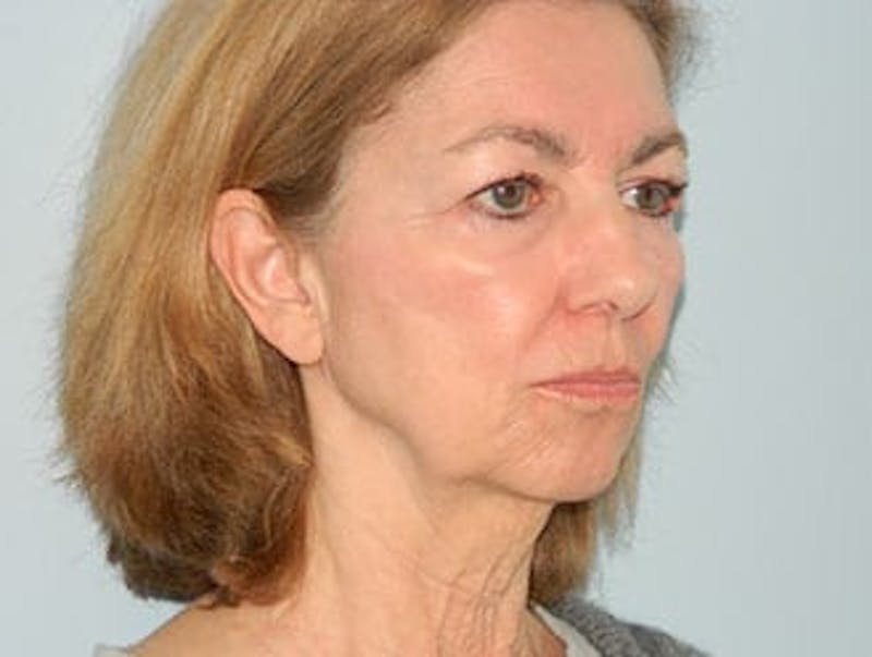 Chin Augmentation Before & After Gallery - Patient 133066593 - Image 1