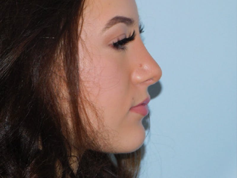 Rhinoplasty Before & After Gallery - Patient 133066594 - Image 4