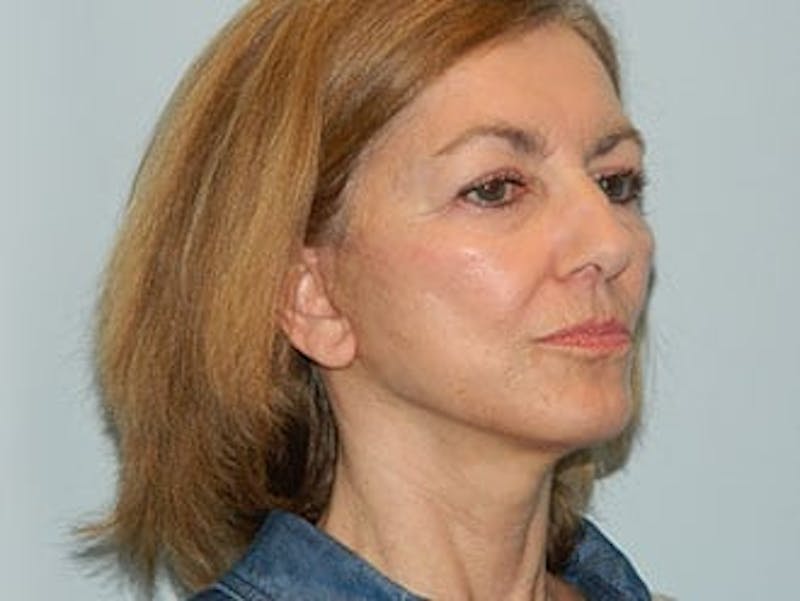 Chin Augmentation Before & After Gallery - Patient 133066593 - Image 2