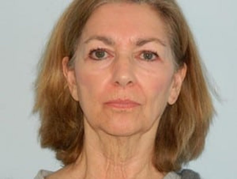 Chin Augmentation Before & After Gallery - Patient 133066593 - Image 3