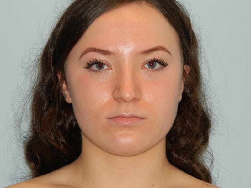 Rhinoplasty Before & After Gallery - Patient 133066594 - Image 5