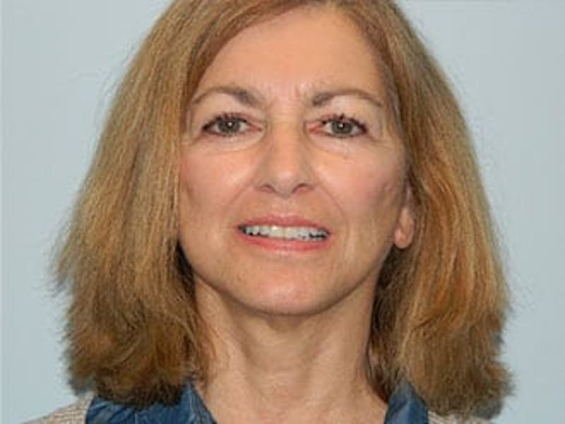 Chin Augmentation Before & After Gallery - Patient 133066593 - Image 4