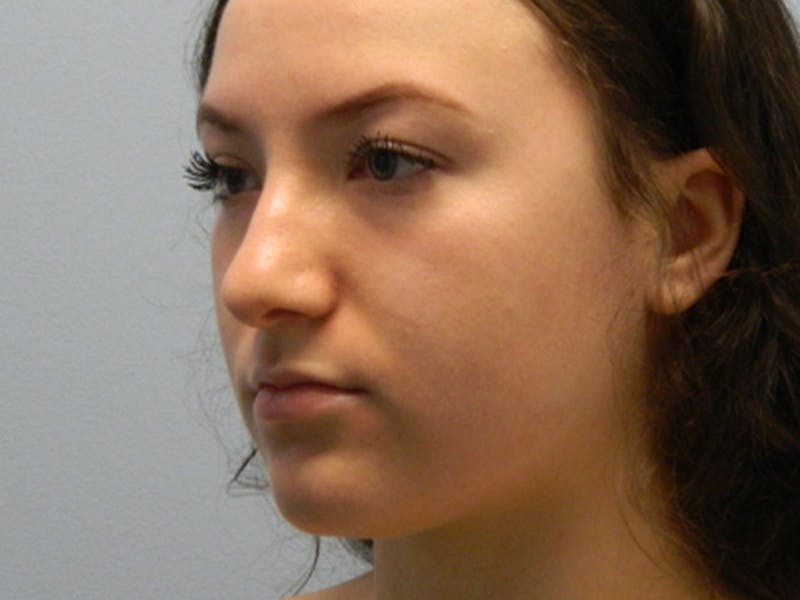 Rhinoplasty Before & After Gallery - Patient 133066594 - Image 7