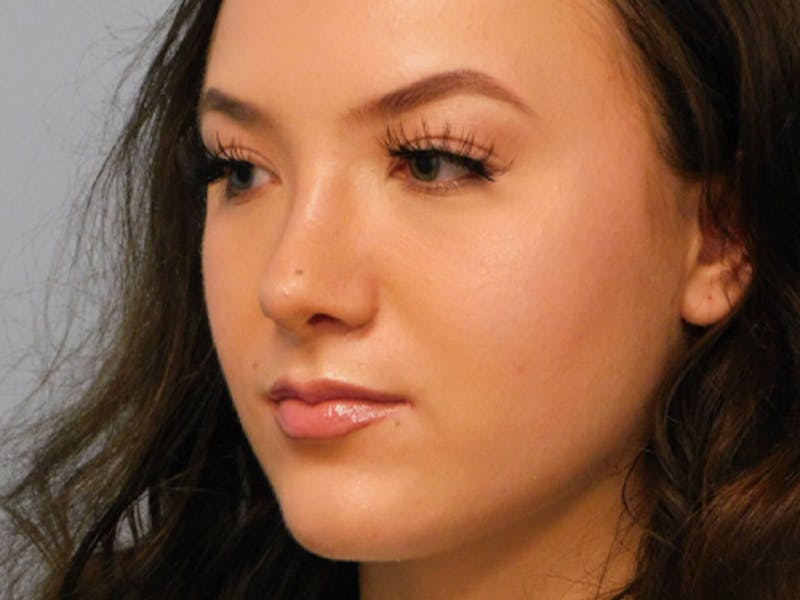 Rhinoplasty Before & After Gallery - Patient 133066594 - Image 8