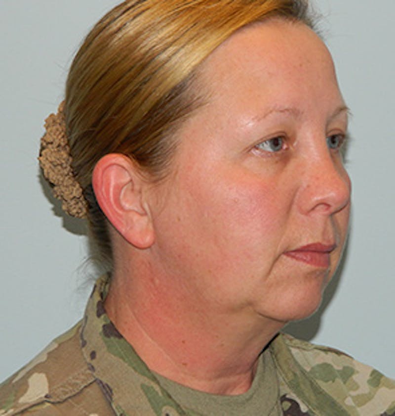 Chin Augmentation Before & After Gallery - Patient 133066596 - Image 5