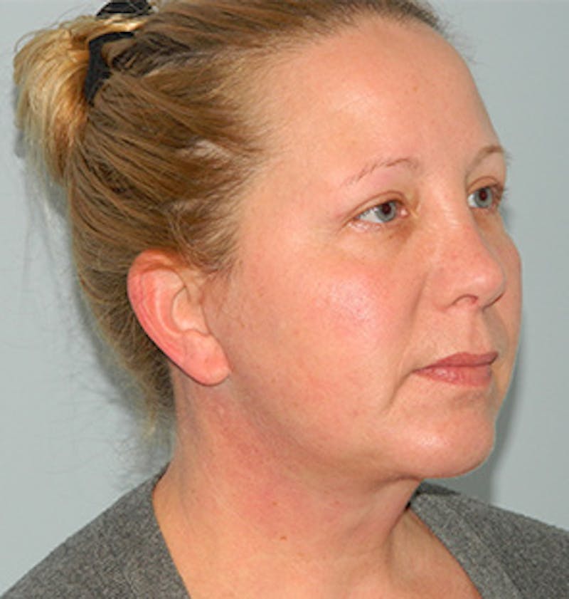 Chin Augmentation Before & After Gallery - Patient 133066596 - Image 6