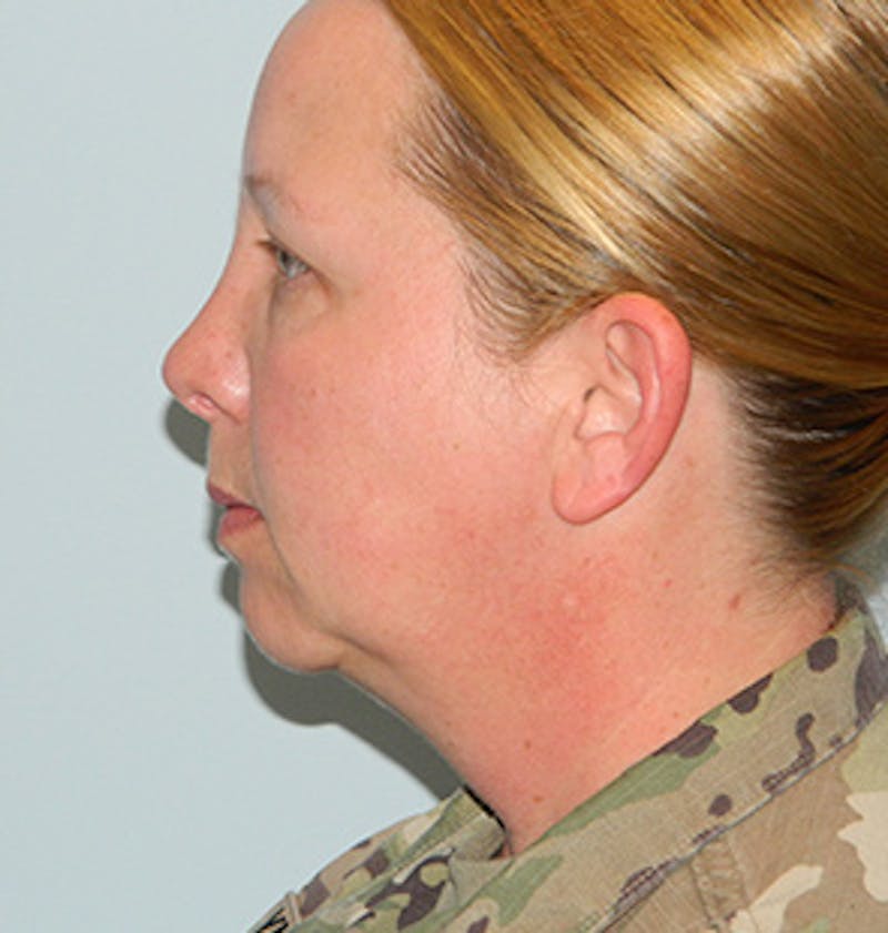 Chin Augmentation Before & After Gallery - Patient 133066596 - Image 7
