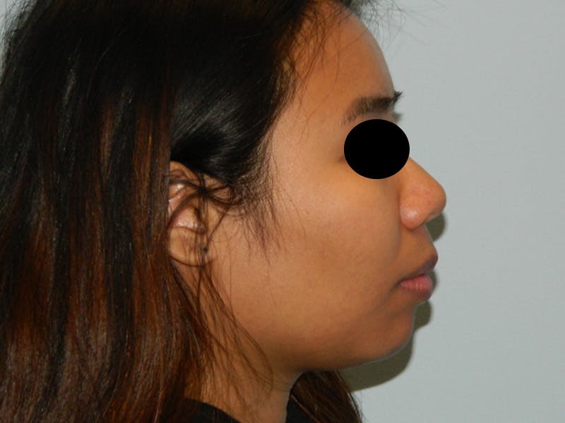 Chin Augmentation Before & After Gallery - Patient 133066598 - Image 1