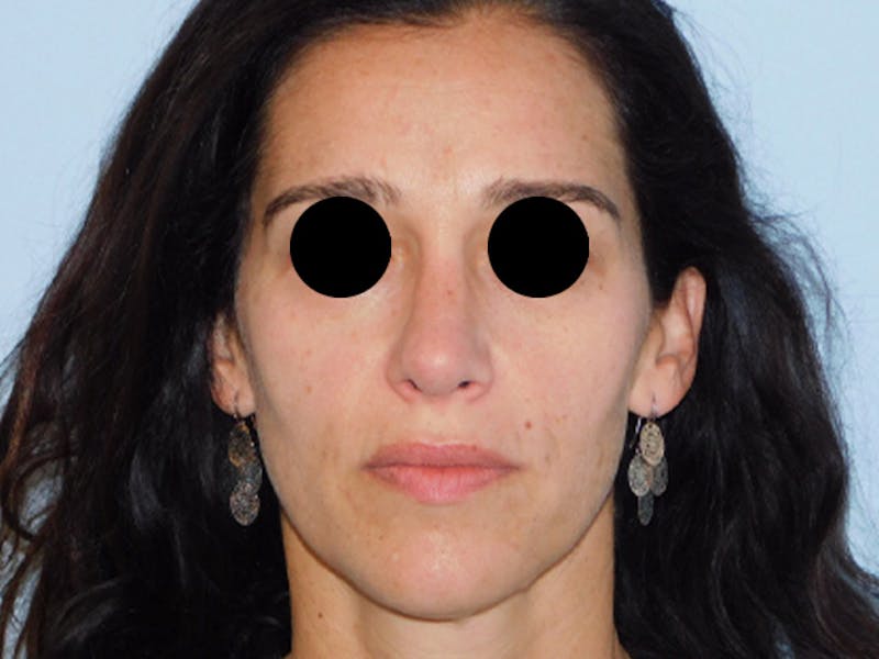 Rhinoplasty Before & After Gallery - Patient 133066597 - Image 6