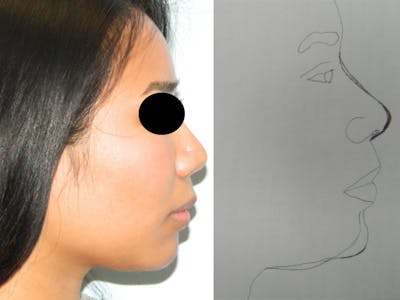 Chin Augmentation Before & After Gallery - Patient 133066598 - Image 2
