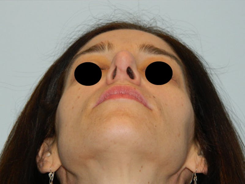 Rhinoplasty Before & After Gallery - Patient 133066597 - Image 9