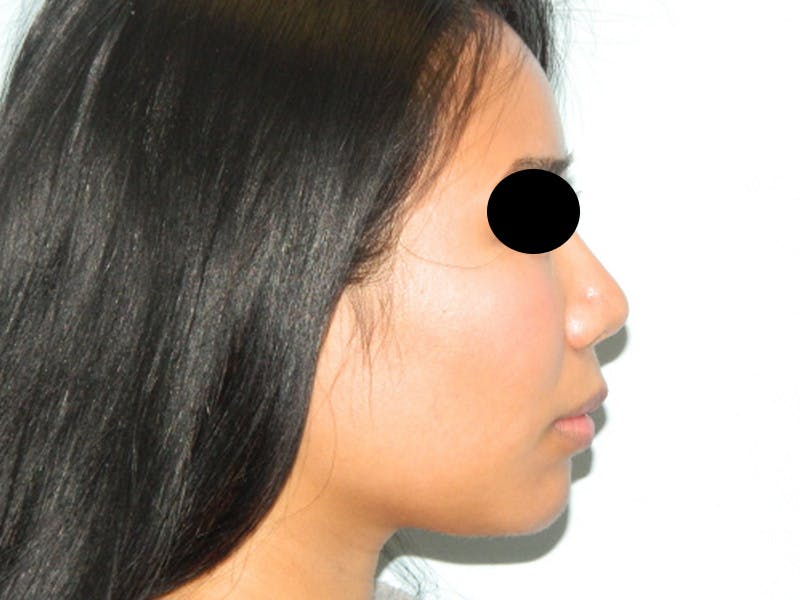 Chin Augmentation Before & After Gallery - Patient 133066598 - Image 4