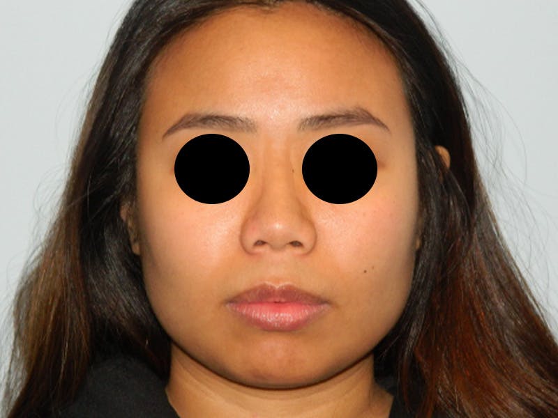 Chin Augmentation Before & After Gallery - Patient 133066598 - Image 5