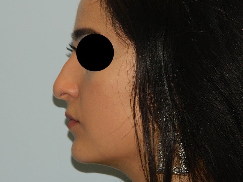 Rhinoplasty Before & After Gallery - Patient 133066603 - Image 1