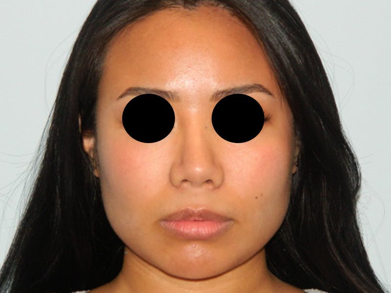 Chin Augmentation Before & After Gallery - Patient 133066598 - Image 6