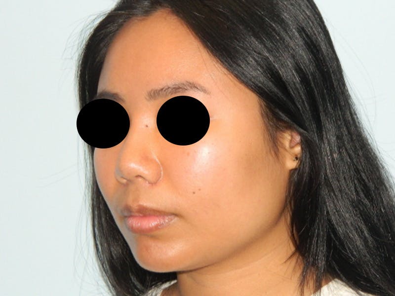 Chin Augmentation Before & After Gallery - Patient 133066598 - Image 7