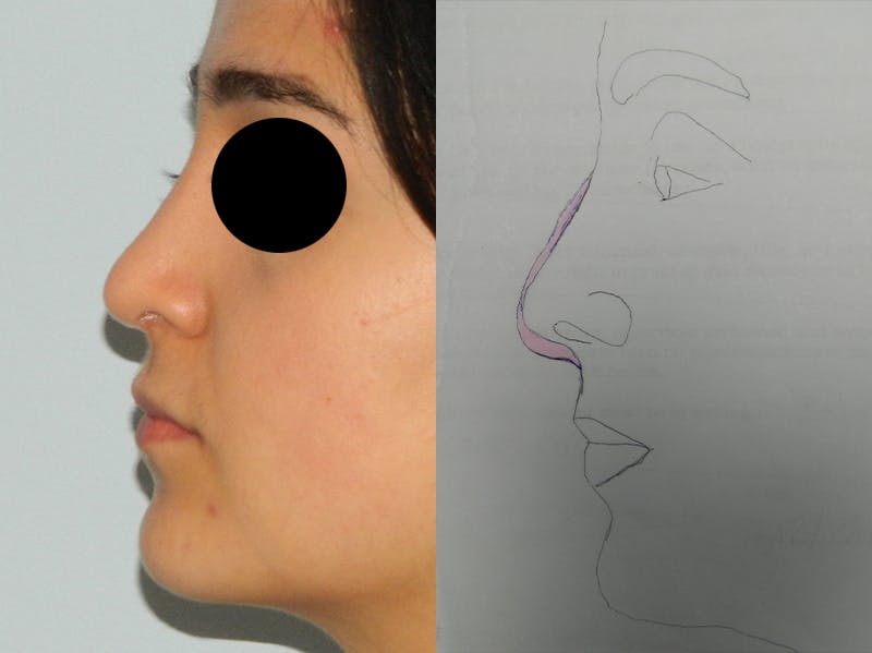 Rhinoplasty Before & After Gallery - Patient 133066603 - Image 2