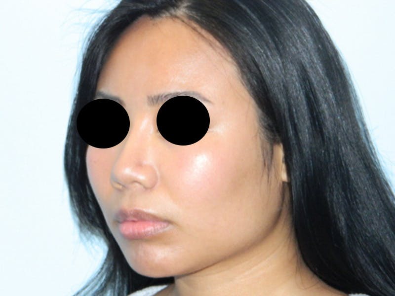 Chin Augmentation Before & After Gallery - Patient 133066598 - Image 8