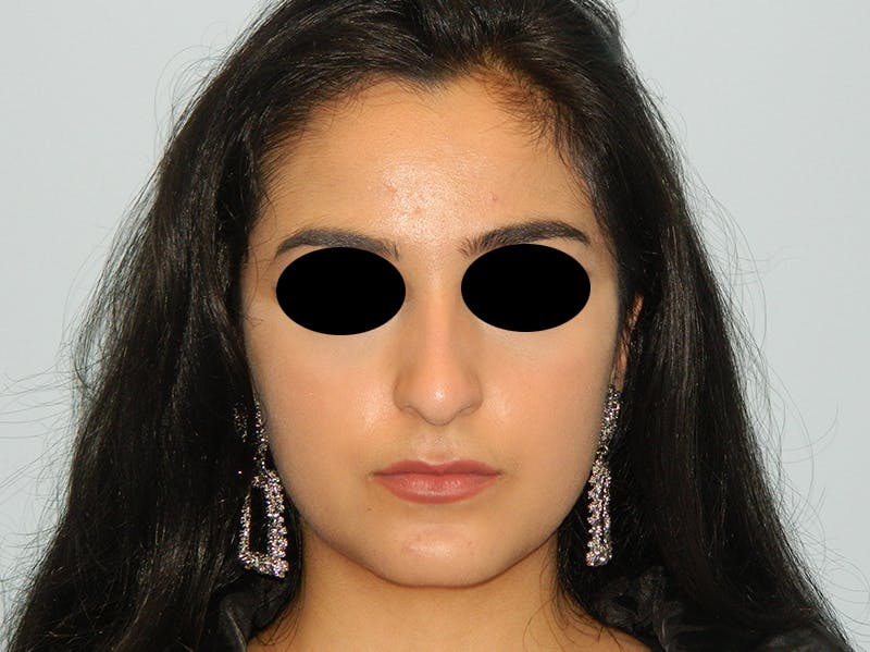 Rhinoplasty Before & After Gallery - Patient 133066603 - Image 3