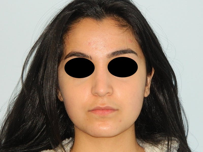 Rhinoplasty Before & After Gallery - Patient 133066603 - Image 4