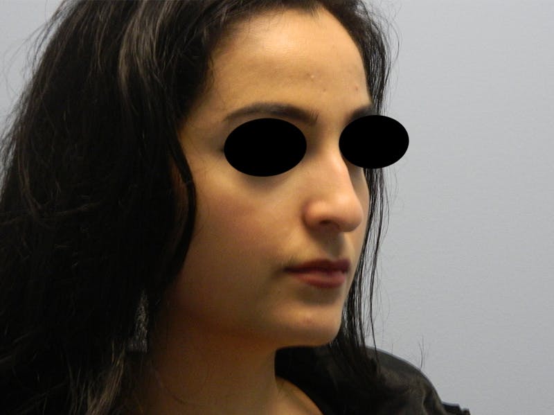 Rhinoplasty Before & After Gallery - Patient 133066603 - Image 5