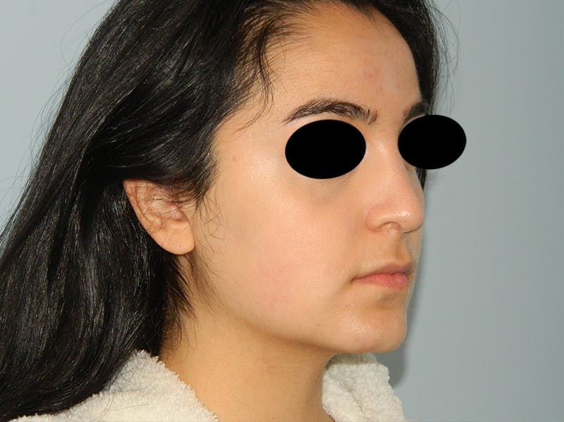 Rhinoplasty Before & After Gallery - Patient 133066603 - Image 6