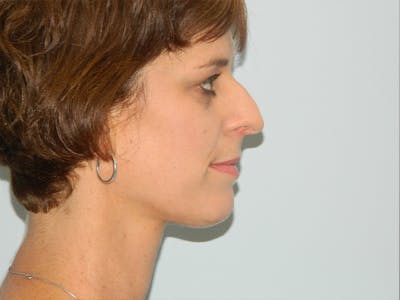 Rhinoplasty Before & After Gallery - Patient 133066606 - Image 1