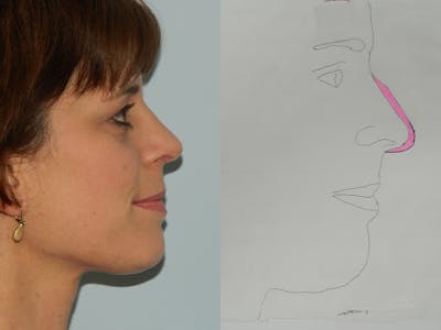 Rhinoplasty Before & After Gallery - Patient 133066606 - Image 2