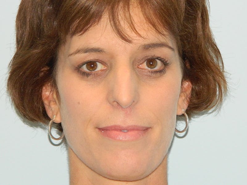 Rhinoplasty Before & After Gallery - Patient 133066606 - Image 3