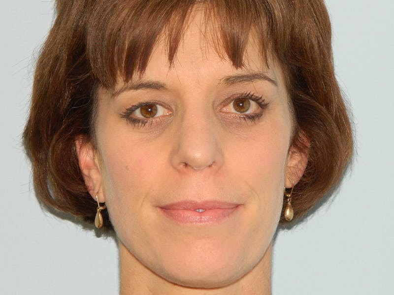Rhinoplasty Before & After Gallery - Patient 133066606 - Image 4