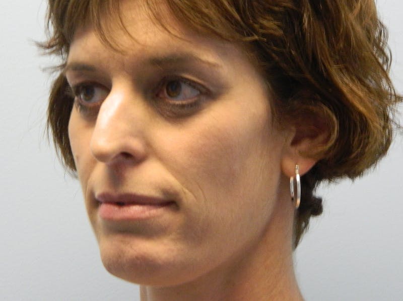 Rhinoplasty Before & After Gallery - Patient 133066606 - Image 5