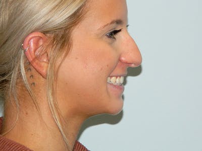 Rhinoplasty Before & After Gallery - Patient 133066615 - Image 1